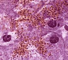 hemosiderin, MRI