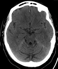 superficial siderosis CT