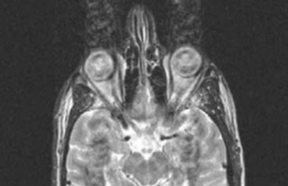 motion artifact MRI