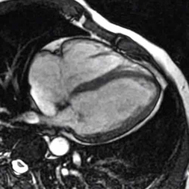 True FISP/ FIESTA cardiac image