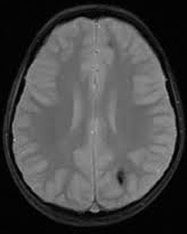 Gradient Echo (GRE) sensitivity to hemorrhage, calcification