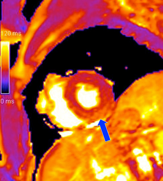 T2 map ischemia