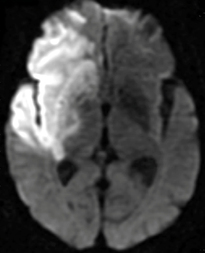 Causes of restricted diffusion MRI