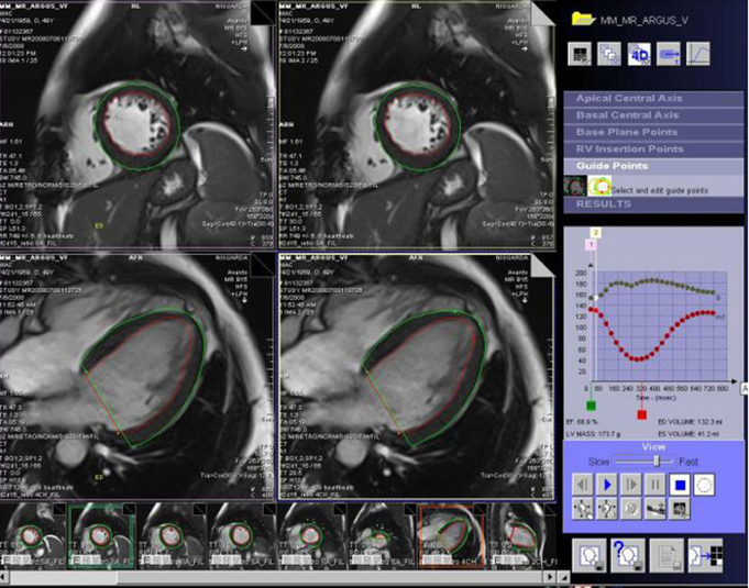 LV function analysis MRI