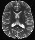 Diffusion MR images