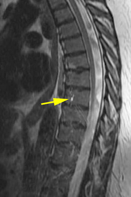 Star artifact MRI