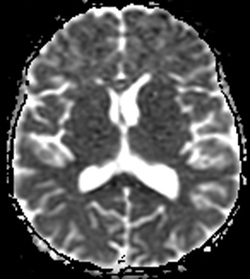 Diffusion MR images