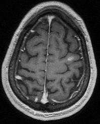 field strength and gadolinium contrast