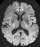 Diffusion MR images