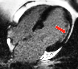 CE myocardial infarction