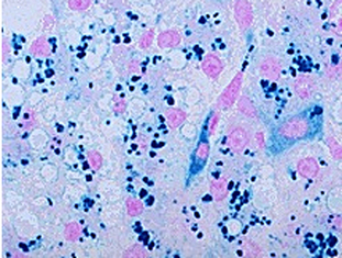 hemosiderin in Kupffer cells