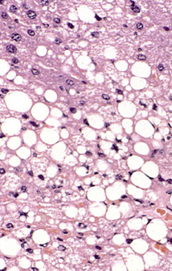 hepatic steatosis