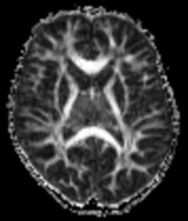 Fractional anisotropy map