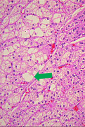 In-phase/Out-of-phase MRI: adrenal adenoma