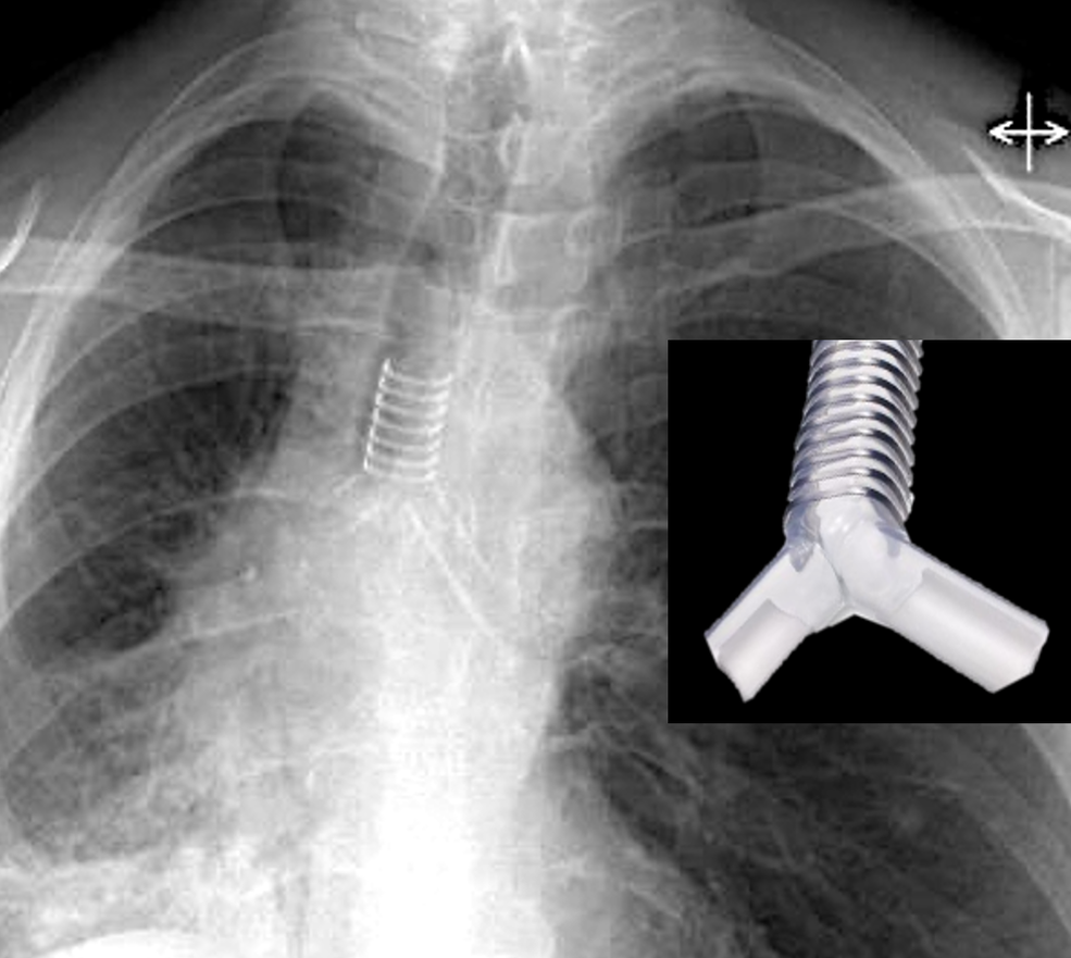 Dynamic™ Y-Stent (Boston Scientific)