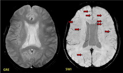 SWI (susceptibility-weighted imaging) vs T2* GRE 