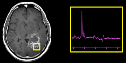 MRI vs MRS