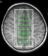 2d Chemical shift imaging MRS