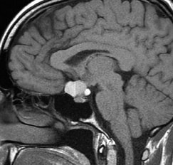 MRI, T1, cholesterol, craniopharyngioma