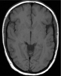 gadolinium accumulation in tissues