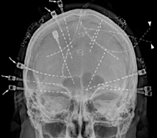 Multiple depth electrodes