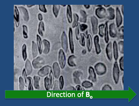 Stacking of sickle cells in a magnetic field